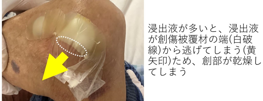 デュオアクティブ 適応 7-997-01 デュオアクティブ ET 50 100mm 滅菌済 個包装 20枚入 ET51020