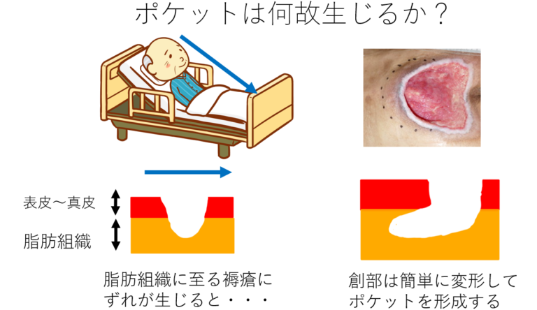 褥瘡圧抜き 方法: 背抜き 尻抜き かかと抜き – CRXB