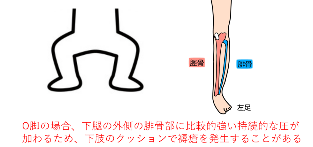 エアマット 褥瘡好発部位