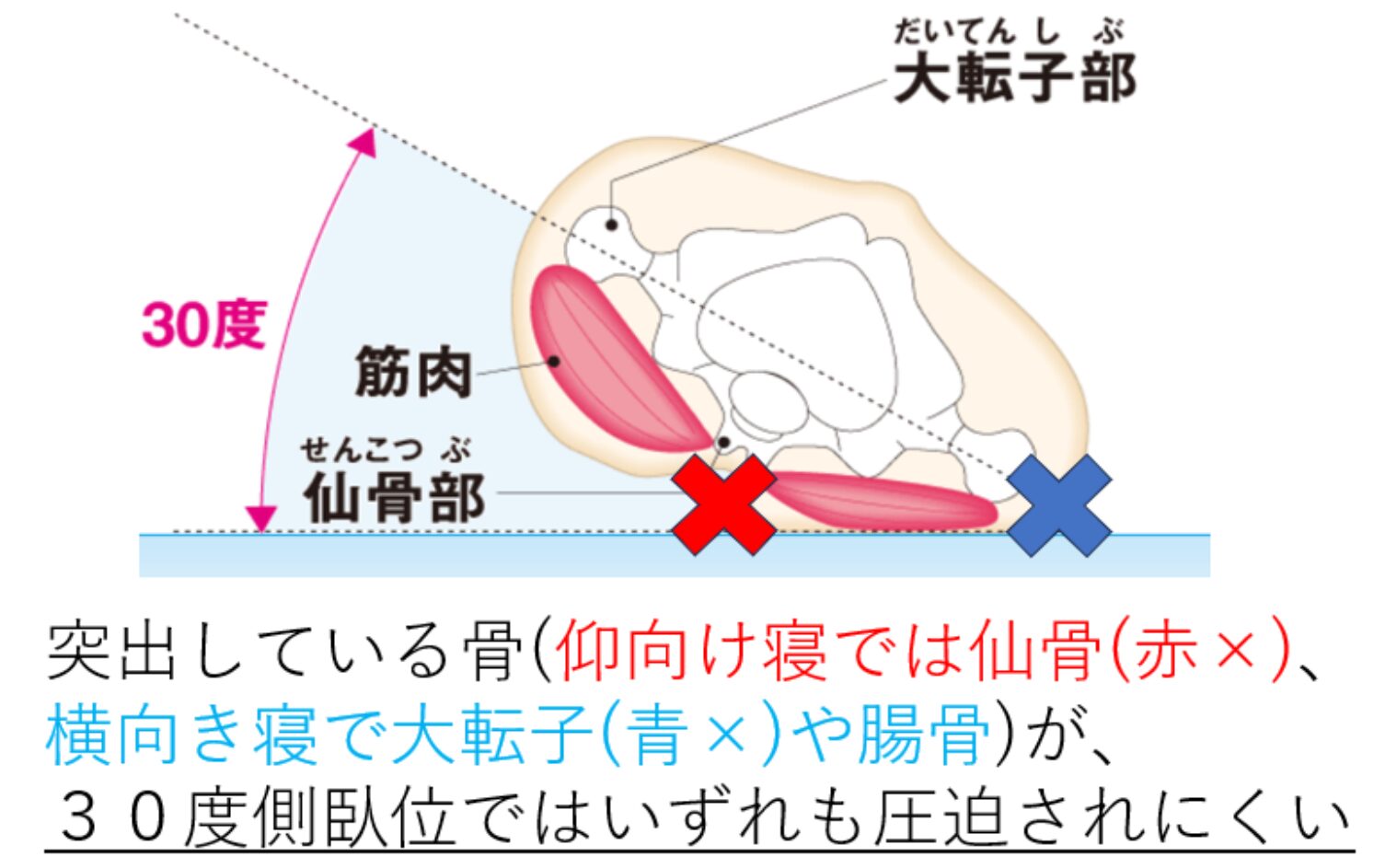 ⑥褥瘡治療の道標 ”TIME+α”の+α(外力・全身状態):褥瘡部位により大きく異なる外力対策!+栄養管理のポイント~まとめ(訪問診療で必須の ...