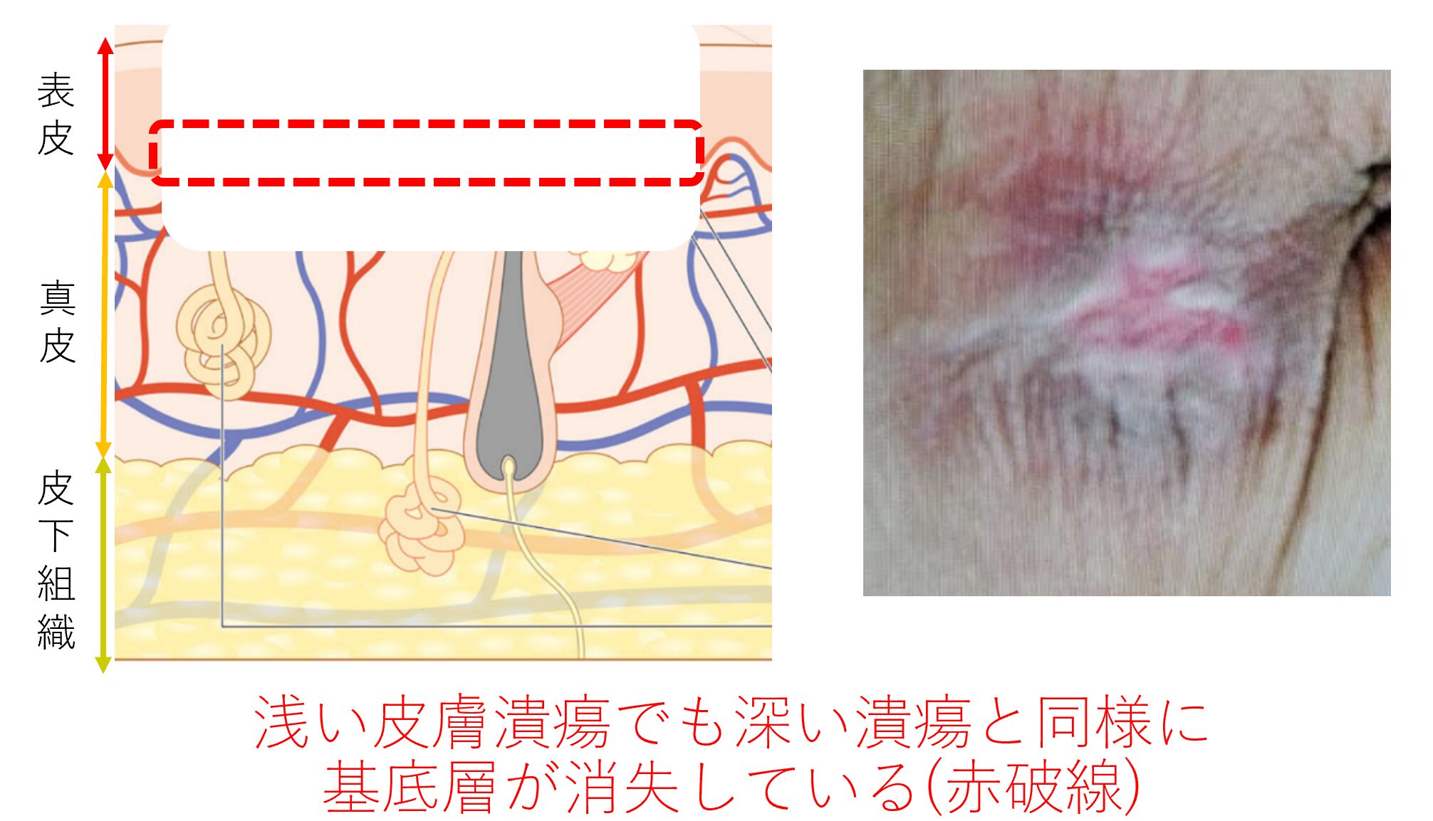 褥瘡が悪化すると _ 褥瘡になりやすい部位 _ 褥瘡(床ずれ)|一般社団法人 日本創傷外科学会 一般の皆様へ – HVWPTR